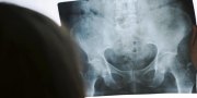 New Research Sheds Light on Chiropractic and X-ray